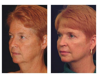 Lower Face and Neck Lift