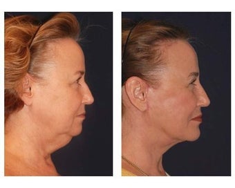 Lower Face and Neck Lift