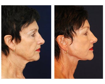 Lower Face and Neck Lift