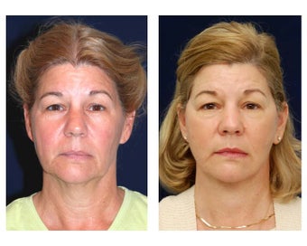 Lower Face and Neck Lift