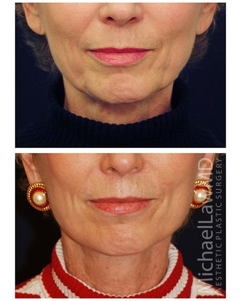 Lower Face and Neck Lift