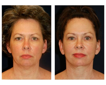 Facial Rejuvenation