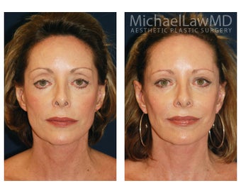 Facial Rejuvenation