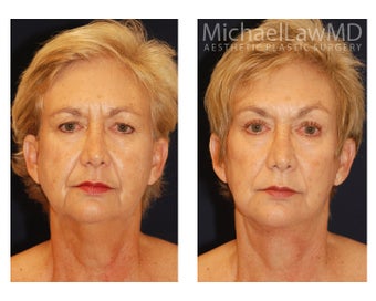 Facial Rejuvenation