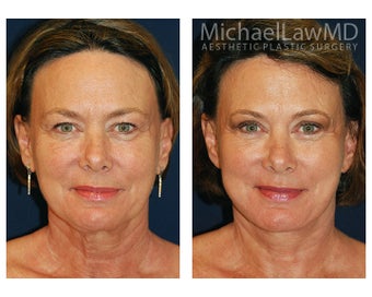 Facial Rejuvenation