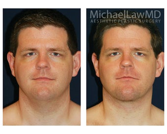 Lower Face and Neck Lift