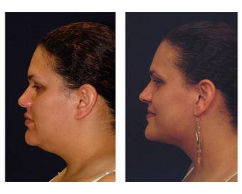 Lower Face and Neck Lift
