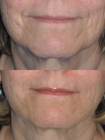 HA filler for "liquid face lift"