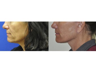 Lower Facelift/Neck LIft