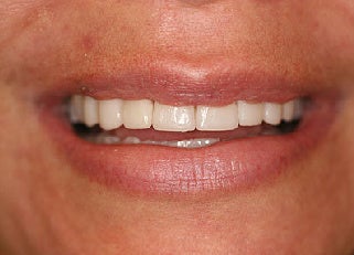 Smile makeover with Lumineers and Invisalign