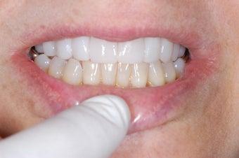 Lumineers Dental Veneers