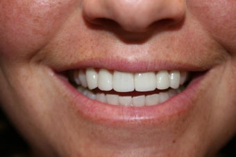 Veneers 