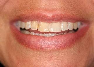 Smile makeover with Lumineers and Invisalign