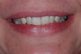 Combination Invisalign and Lumineers