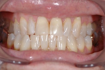 Lumineers Dental Veneers