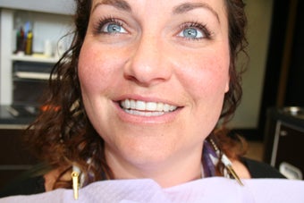 Veneers 