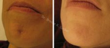 Starlux 1540 for Scar removal and skin plumping