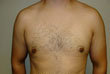 Gynecomastia and Power Assisted Liposuction