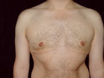 Gynecomastia Reduction Surgery