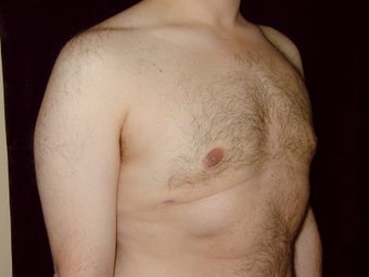 Gynecomastia Reduction Surgery
