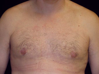 Gynecomastia Reduction Surgery