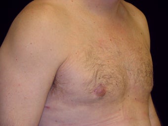 Gynecomastia Reduction Surgery