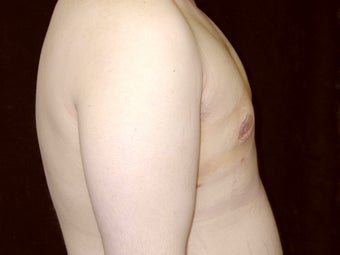 Gynecomastia Reduction Surgery