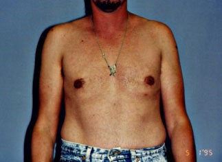 Male Breast Reduction