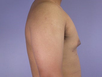 Male Breast Reduction