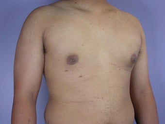 Male Breast Reduction