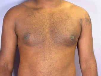 Male Breast Reduction
