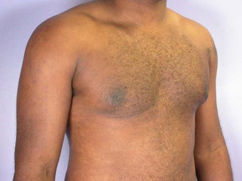 Male Breast Reduction