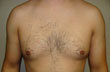 Gynecomastia and Power Assisted Liposuction