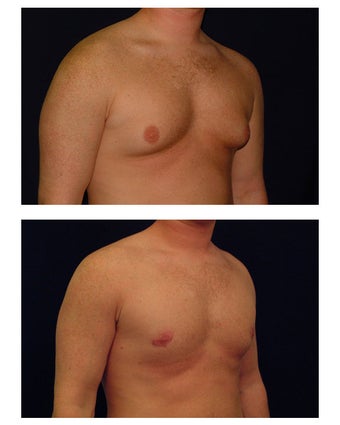 Gynecomastia (Male Breast Reduction)