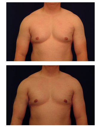 Gynecomastia (Male Breast Reduction)