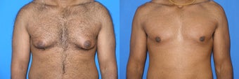 Male breast reduction (gynecomastia)
