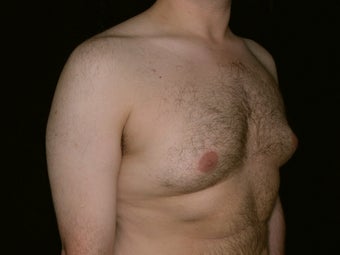 Gynecomastia Reduction Surgery