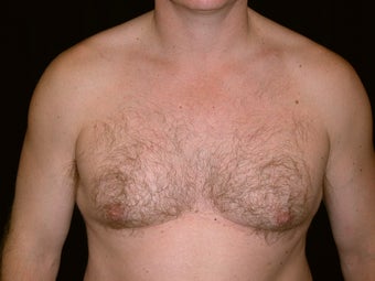 Gynecomastia Reduction Surgery