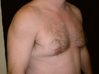Gynecomastia Reduction Surgery