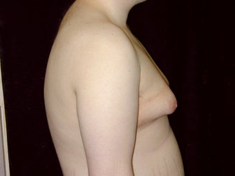 Gynecomastia Reduction Surgery