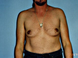 Male Breast Reduction