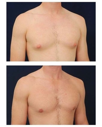 Gynecomastia