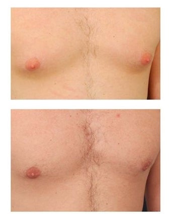 Gynecomastia