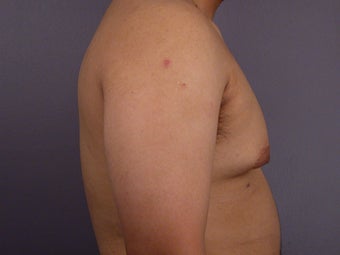 Male Breast Reduction
