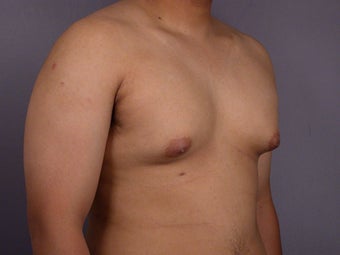 Male Breast Reduction