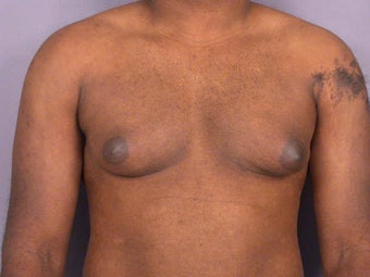 Male Breast Reduction