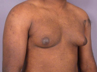 Male Breast Reduction