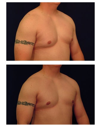 Gynecomastia / Male Breast Reduction