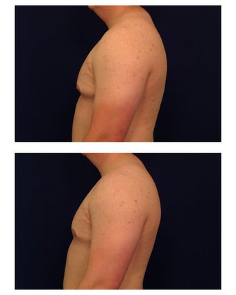 Gynecomastia / Male Breast Reduction