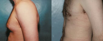Gynecomastia (Male Breast Reduction)